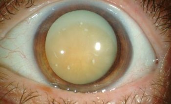 Что мы знаем о таком заболевании как катаракта