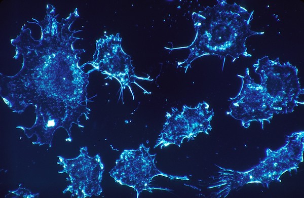 Иммунотерапия: новое слово в лечении рака за границей